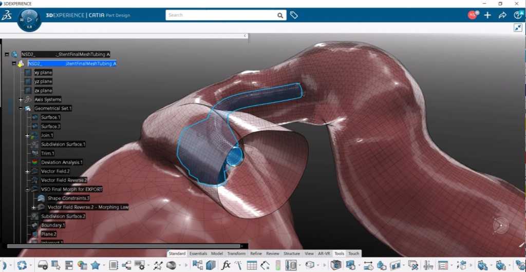 Una aneurisma cerebral identificada en el marco del proyecto Living heart project de Dassault Systèmes.